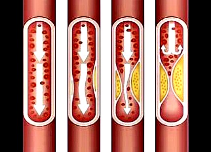 Atherosclerose valt slagaders aan en interfereert met de bloedstroom.