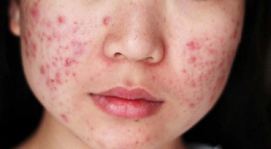 Het proces van de vorming van acne vulgaris bestaat uit vier fasen